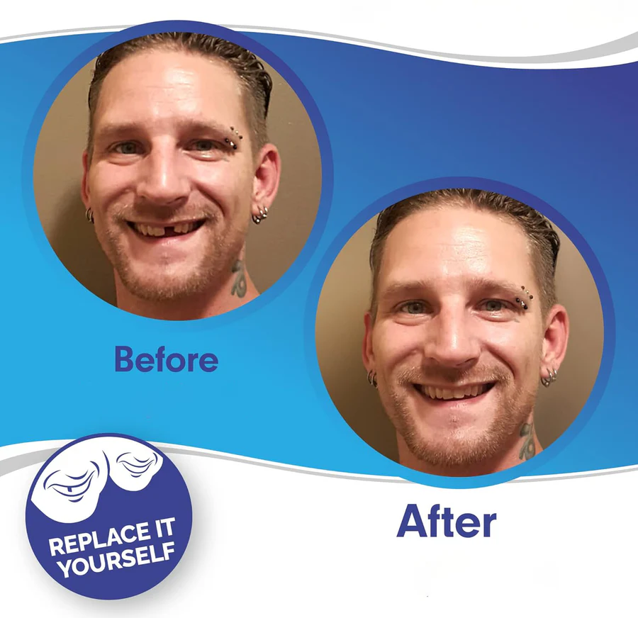 Full Dental Veneer Kit – Upper & Lower Cosmetic Covers