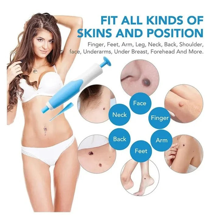 Skin Tag Removal Kit with Silicone Bands & Pen Band Tool