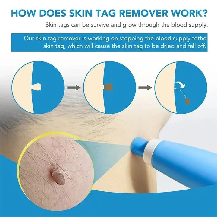 Skin Tag Removal Kit with Silicone Bands & Pen Band Tool