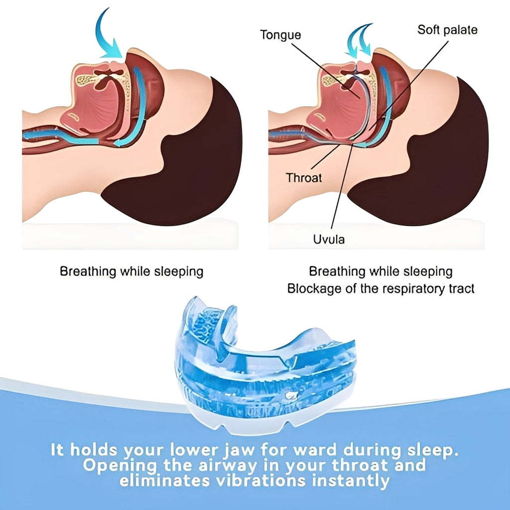 Adjustable Moldable Mouthpiece with Screw Based Fit for Nighttime Use