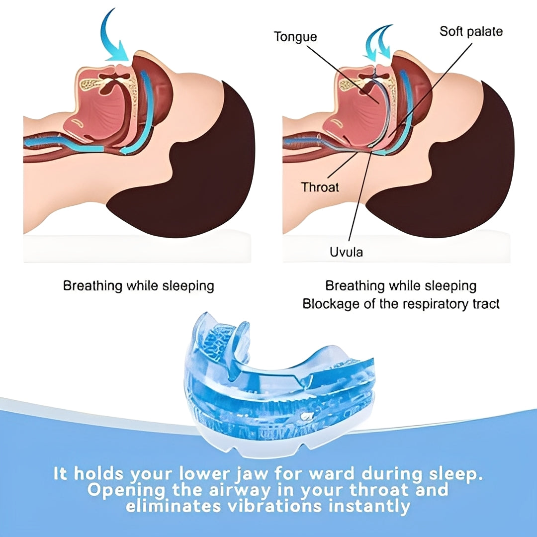 Adjustable Moldable Mouthpiece with Screw Based Fit for Nighttime Use
