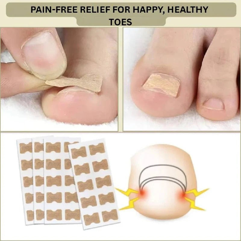 Ingrown Nail Correction Tool with Instant Repair Treatment