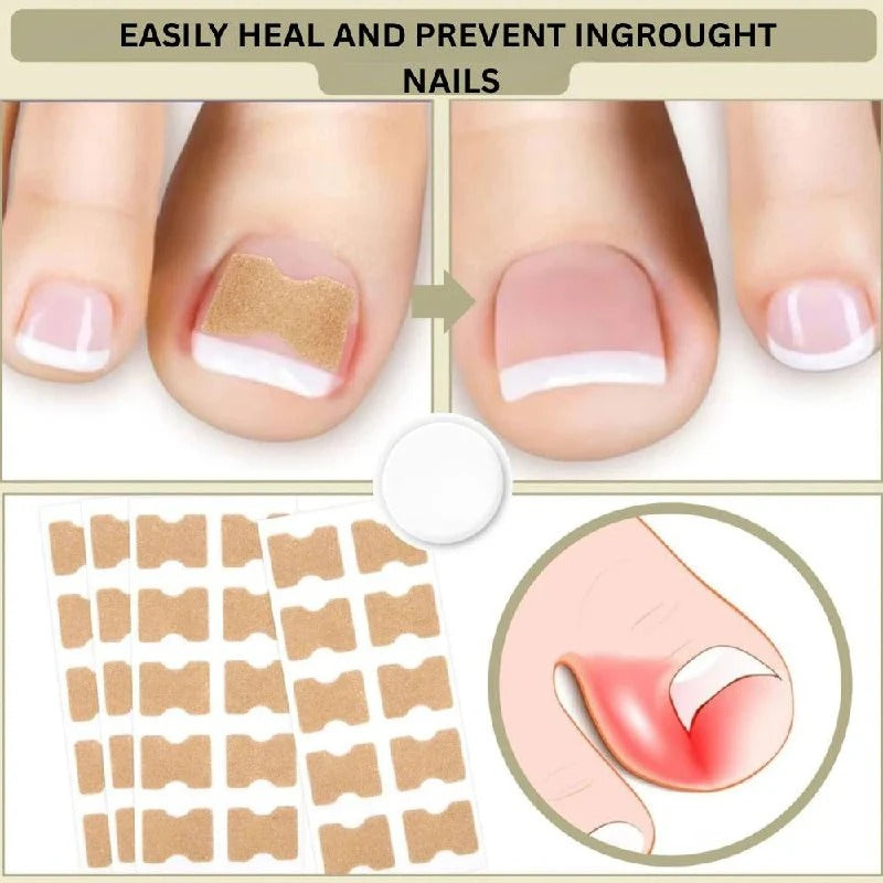 Ingrown Nail Correction Tool with Instant Repair Treatment