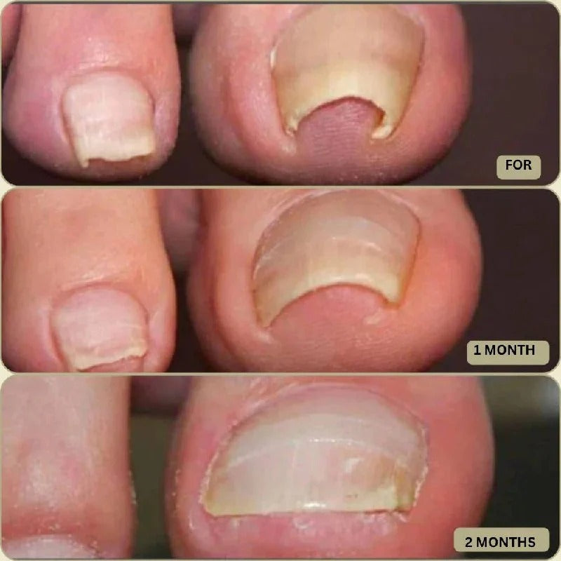 Ingrown Nail Correction Tool with Instant Repair Treatment