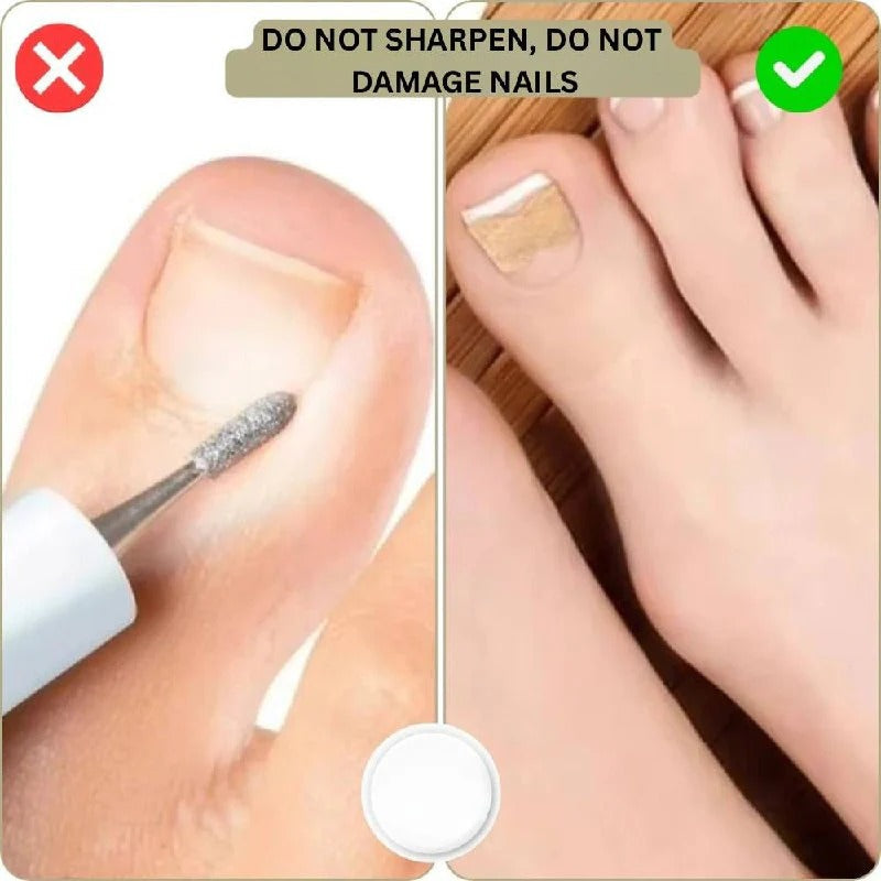 Ingrown Nail Correction Tool with Instant Repair Treatment