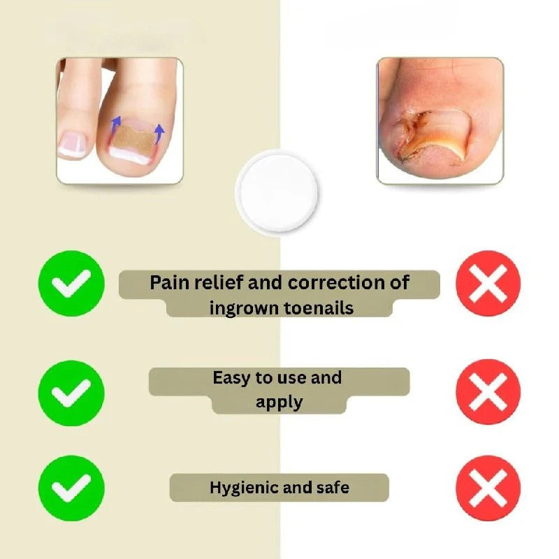 Ingrown Nail Correction Tool with Instant Repair Treatment